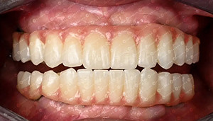 ultimo caso aziendale circa Caso cliente. Blocco di zirconia 4D.