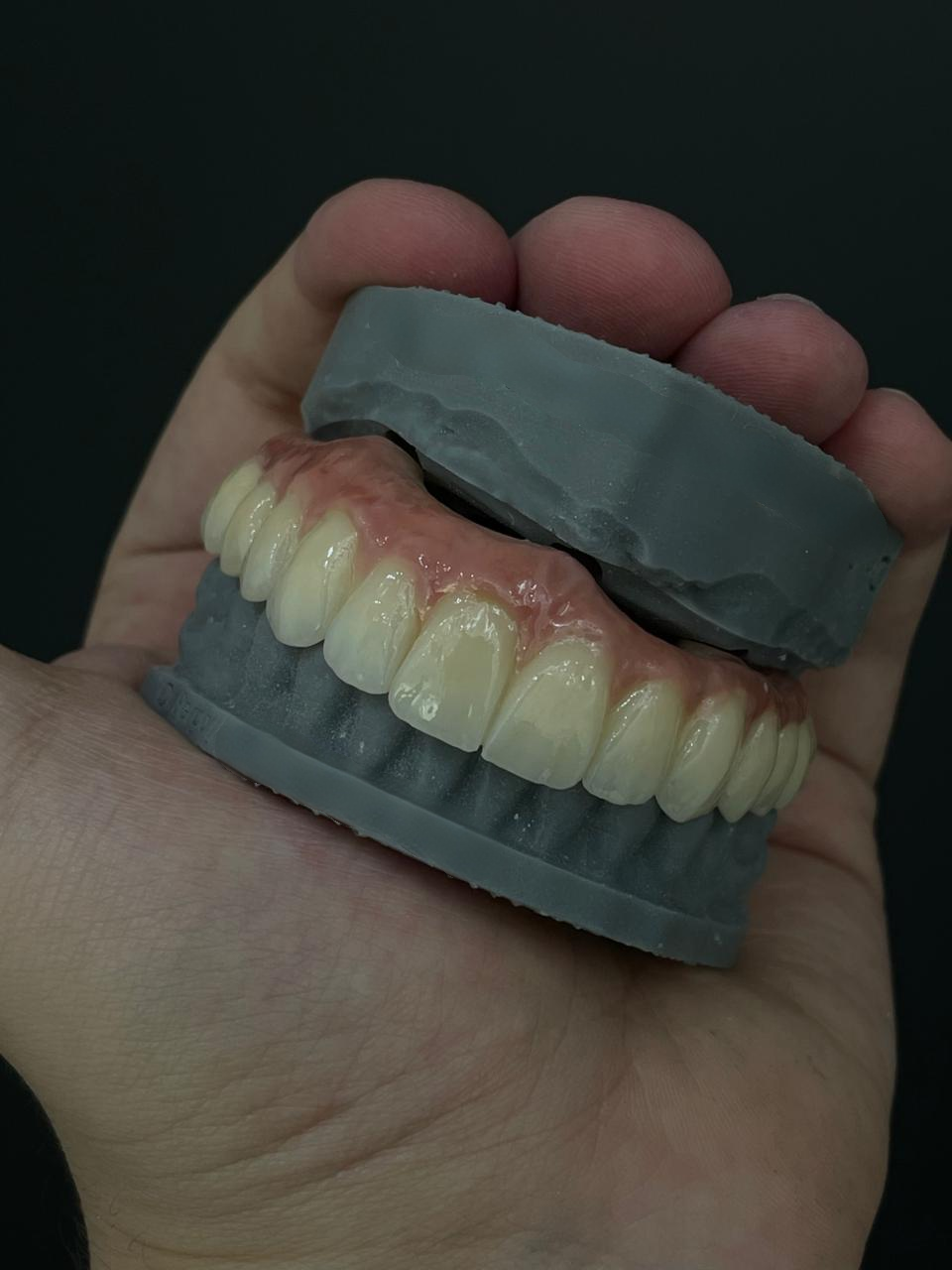ultimo caso aziendale circa Raggiungere un'estetica naturale con la zirconio: un caso di restauro di arcata completa di successo dal Brasile