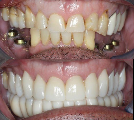 Yucera 4D Pro Dental - Specific Zirconia Ceramic Block with HT Plus Technology Improving the Quality of Restorations