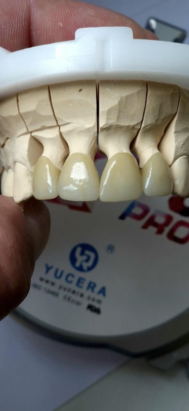Yucera 4D Pro Dental Zirconia Blocks Precision Crafted for Durability
